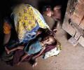 NHRC notice to MP government over death of 116 children due to malnutrition