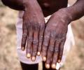 US confirms first case of monkeypox