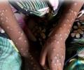 Prevent undue panic: Centre advises states on mpox