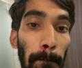 COVID testing: Indian badminton player shares picture of bleeding nose