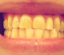 Discoloured, yellow teeth? What you need to know