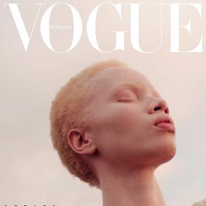 How this model with albinism created history