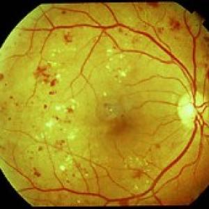 IIT-KGP makes software to detect retinopathy