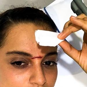 Kangana Ranaut gets injured on the sets of Manikarnika