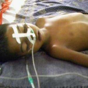 Encephalitis toll rises to 102 in Bengal, 43 in Assam