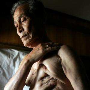 This 86-yr-old lives with the scars of a nuclear war