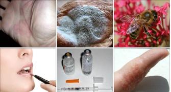 Different types of allergies: What you should know