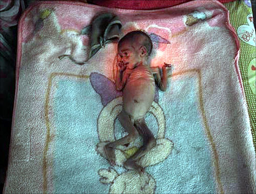 our-month-old Vishakha, who weighs 2.3 kg (5 lbs) and suffers from severe malnutrition, has her picture taken as she lies on a bed at the Nutritional Rehabilitation Centre of Shivpuri district in Madhya Pradesh.