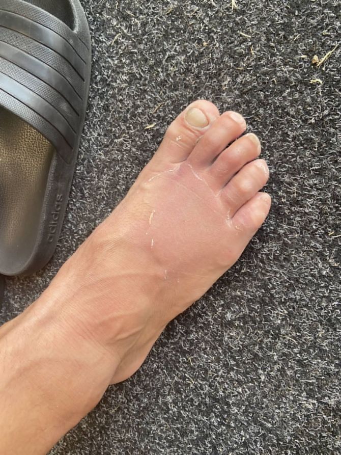 The Black Caps put out this picture of Neil Wagner's broken toes on their Twitter handle. 