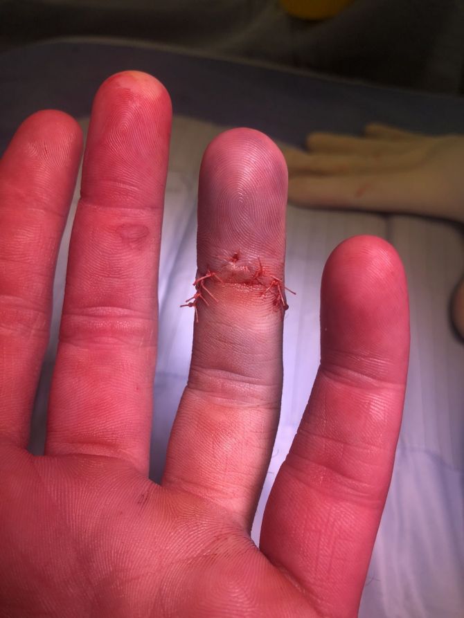 Jimmy Neesham tweeted a photo of his finger in stiches after the surgery
