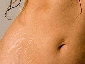 women stretch marks