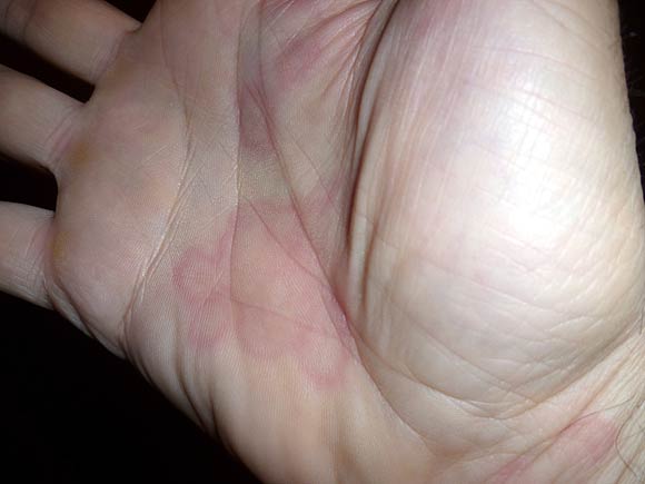 Urticaria is a skin rash caused by viral allergies