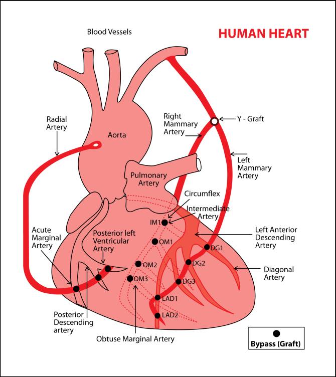 12 blockages were removed from the heart of a patient at the Asian Heart Institute. This is the graphical representation of those blocks.