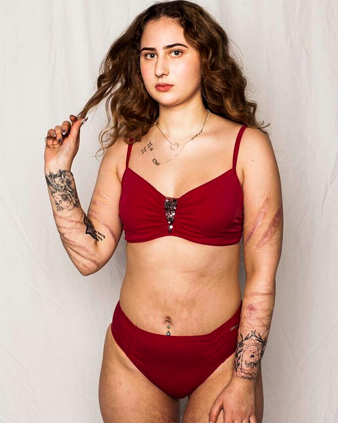 Beautiful And Brave A Burn Survivor Is Helping People Embrace Their Scars Get Ahead