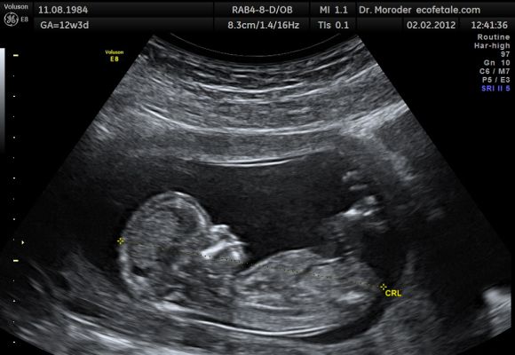 Ultrasound image of a foetus.