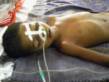 A child affected by encephalitis admitted in BRD Medical College in Gorakhpur
