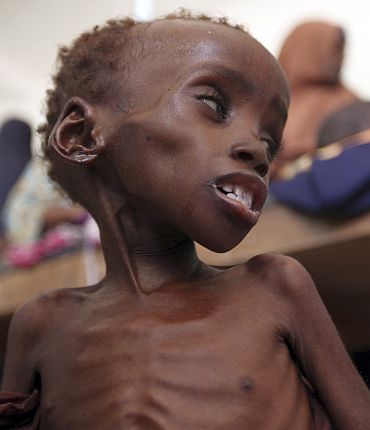 A malnourished child is seen inside a ward at Banadir hospital in Somalia's capital Mogadishu