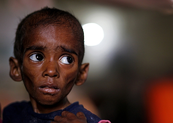 Ranbir, twenty-six-months, who weighs 5 kg and suffers from severe malnutrition, waits for food at the Nutritional Rehabilitation Centre of Shivpuri district in Madhya Pradesh