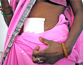 A woman who was operated on at the Chhattisgarh camp