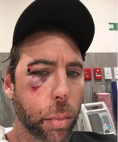 Grant Hackett beaten and bruised