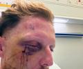 Ben Stokes undergoes successful eye surgery