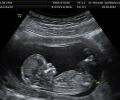 US doctors perform heart surgery on 25-week foetus