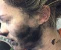 Woman's face burned after headphones explode mid-flight