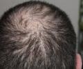 Mysterious hair loss outbreak reported in Maha villages