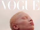 How this model with albinism created history