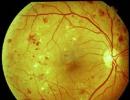 IIT-KGP makes software to detect retinopathy