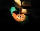 15 lose vision after free cataract surgery in Bihar