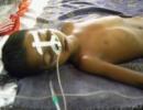 Killer encephalitis targets poor children in Bihar