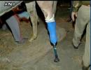 Shaktiman stands on prosthetic limb; amputation successful