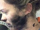 Woman's face burned after headphones explode mid-flight