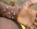 Delhi monkeypox patient attended stag party in Manali