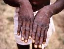 US confirms first case of monkeypox