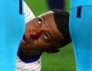 PIX: Mbappe breaks nose after collision at Euros