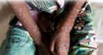 Prevent undue panic: Centre advises states on mpox