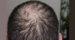 Mysterious hair loss outbreak reported in Maha villages