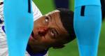 In Pictures - Mbappe breaks nose after collision at Euros