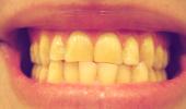 Discoloured, yellow teeth? What you need to know