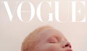 How this model with albinism created history