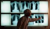 India could be 'efficacy test' for TB drug okayed by US