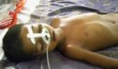 Killer encephalitis targets poor children in Bihar