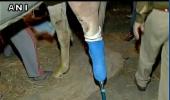 Shaktiman stands on prosthetic limb; amputation successful