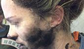 Woman's face burned after headphones explode mid-flight