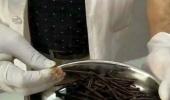 WTF: 116 iron nails removed from man's stomach