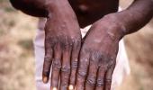 Experts raise alarm after first monkeypox death