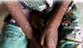 Prevent undue panic: Centre advises states on mpox