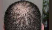 Mysterious hair loss outbreak reported in Maha villages